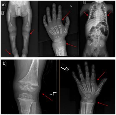 Clinical characteristics and long-term management for patients with vitamin D-dependent rickets type II: a retrospective study at a single center in Saudi Arabia